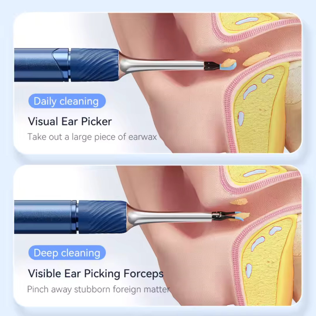 Smart Ear Wax Remover with HD Camera